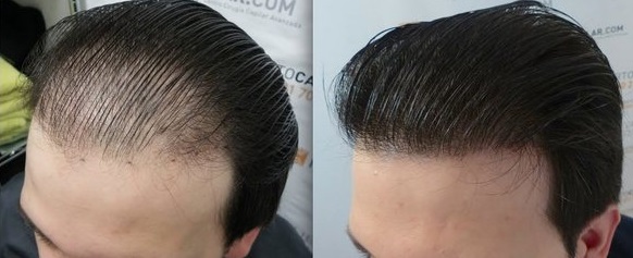Rüyada Erkek Birinin Saç Ektirmesi