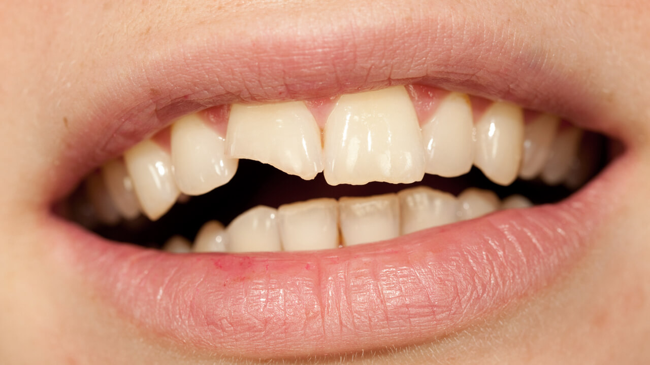 Травматические повреждения зубов