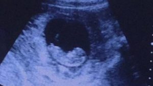 Rüyada Ultrasonda Bebek Kafası Görmek
